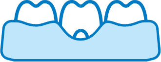 Dessin de 3 dents dans une gencive illustrant les soins de parodontologie, pour la santé des gencives.